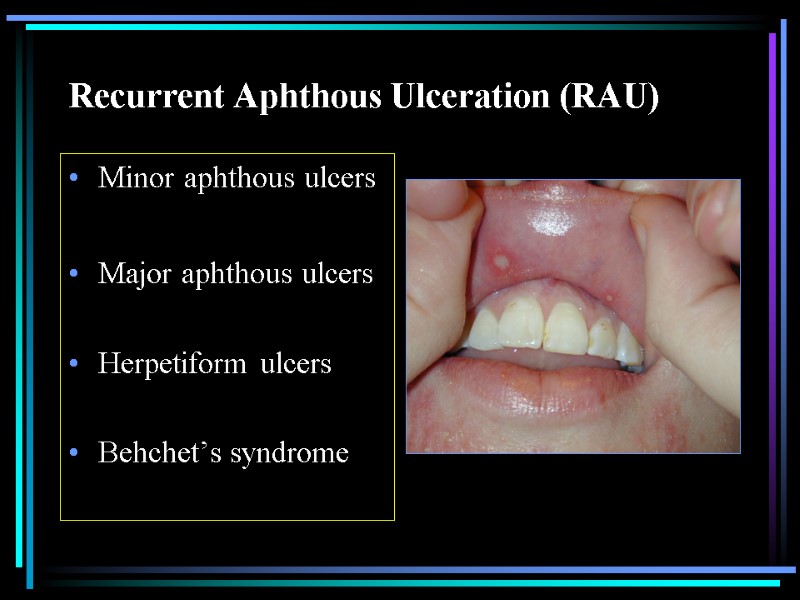 Recurrent Aphthous Ulceration (RAU) Minor aphthous ulcers  Major aphthous ulcers  Herpetiform ulcers